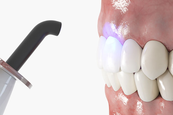 The image displays a close-up view of a person s teeth with a dental tool, likely a scaler or pick, being used near them, suggesting dental cleaning or maintenance.