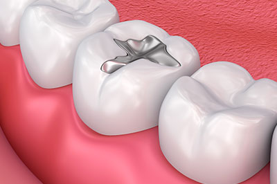 The image shows a close-up of a dental model with a focus on a silver ring embedded between two teeth.