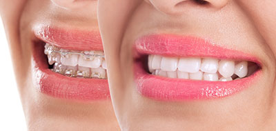 The image displays a close-up of a person s face with a wide smile, showcasing their teeth and lips, which are enhanced by lipstick.