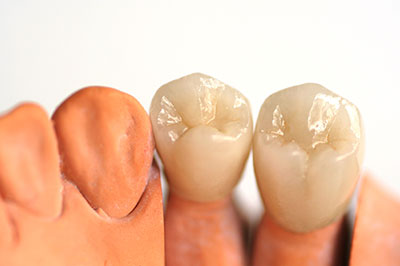 The image shows a set of artificial teeth with visible dental implants, displayed against a white background.