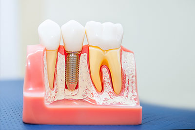 The image shows a close-up view of a dental model with artificial teeth and gums, featuring a metal screw securing an upper front tooth to a tooth implant, set against a blue background that appears to be a table surface.