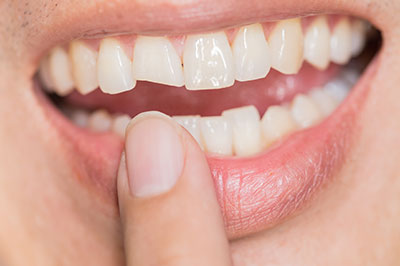 The image shows a close-up view of a person s mouth with teeth, holding a finger up against their teeth, displaying a smile with a noticeable gap between two front teeth.