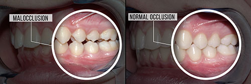 The image shows a series of three photographs with annotations indicating stages of tooth decay, from early to advanced decay, with a focus on oral hygiene education.