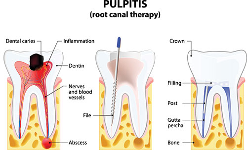 The image shows a detailed illustration of a tooth with annotations indicating different parts of its structure, including pulpitis, root canal therapy, dental caries, crown, filling, dentin, enamel, tongue, and teeth, with labels pointing to each part.