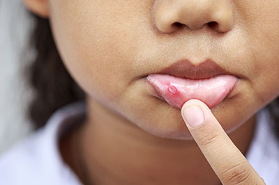 A young person with acne on their face, pressing a finger against their lips, against a blurred background.
