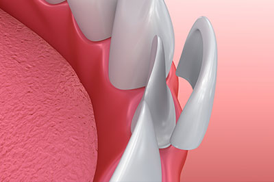 The image shows a close-up view of a dental implant with a pink gum tissue background, highlighting its design and structure.