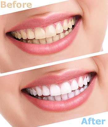 The image shows a before-and-after comparison of a teeth whitening treatment, with two photos side by side featuring a person s smile after the procedure.