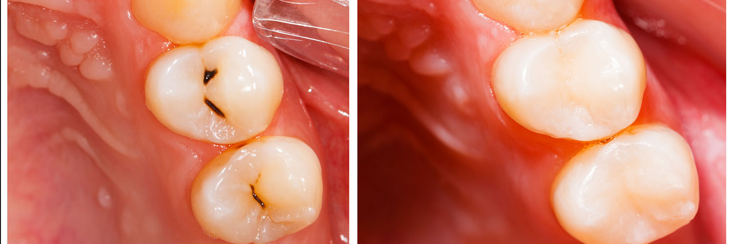 The image shows a close-up view of a person s mouth with teeth, gums, and tongue visible, featuring an area where dental work appears to be in progress, possibly involving a filling or restoration.