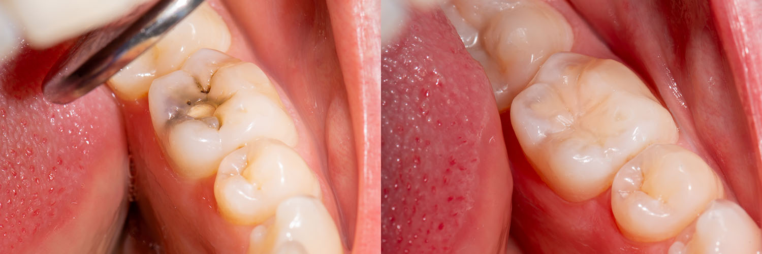This is an image of a close-up view of a mouth with several teeth showing signs of decay and damage.
