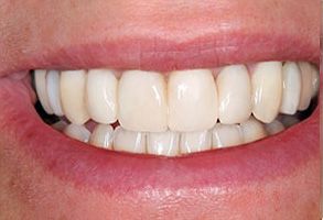 The image shows a close-up of a person s teeth with a wide smile, revealing white fillings and a clean, well-maintained dental appearance.