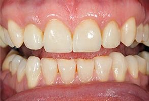 The image shows a close-up view of a person s teeth with a focus on an open mouth revealing yellowed and stained teeth, which appear to be in need of dental care.