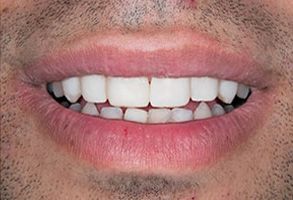 The image shows a close-up of a person s smiling mouth with teeth, revealing a dental implant on the front right side. The individual has a beard and mustache, and there is visible stubble.