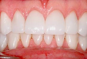 The image shows a close-up view of a person s teeth with a focus on their smile, highlighting the brightness and cleanliness of the teeth.