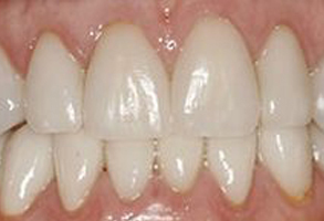 The image shows a close-up view of a person s teeth with an overbite, featuring a mix of natural and possibly veneered teeth.