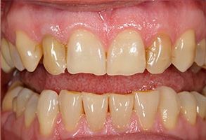 The image shows two photographs of a person s teeth with significant discoloration and decay, which appear to be before and after dental treatment, highlighting the transformation achieved by cleaning and restoration.