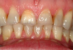 The image shows two views of a person s teeth with significant discoloration and decay, indicating poor oral hygiene and potential dental health issues.
